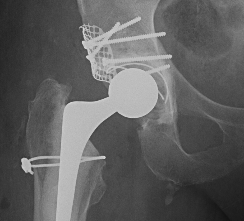 Revision Acetabulum Type IIB Superior Mesh and Impaction Bone Graft